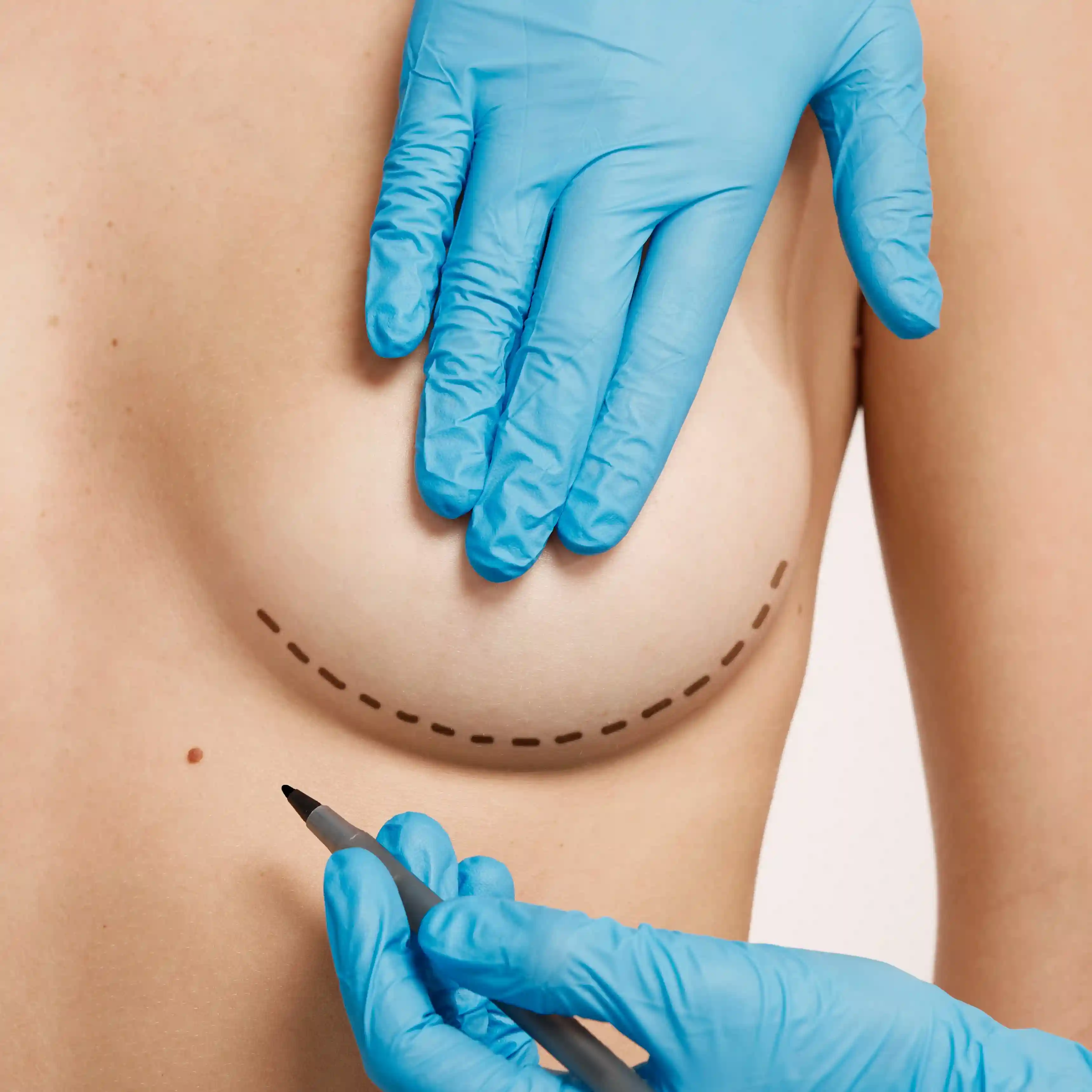 Breast surgery illustration